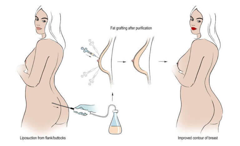Как работает липофилинг груди