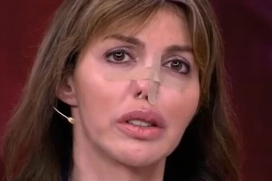 Алиса Казьмина нуждается в пластике: некроз тканей привел к деформации носа