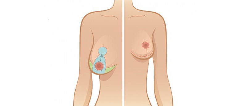 Асимметрия груди после маммопластики