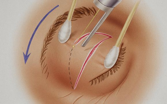 Принцип проведения безоперационной блефаропластики