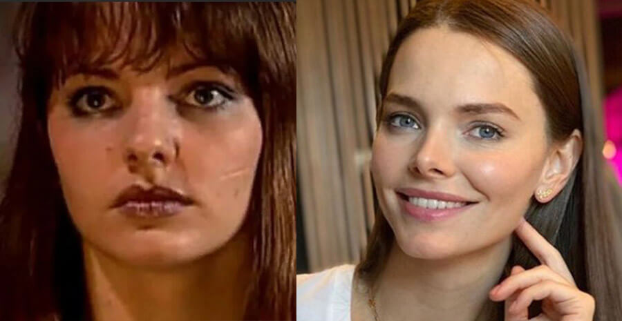 Боярская до и после пластики фото носа