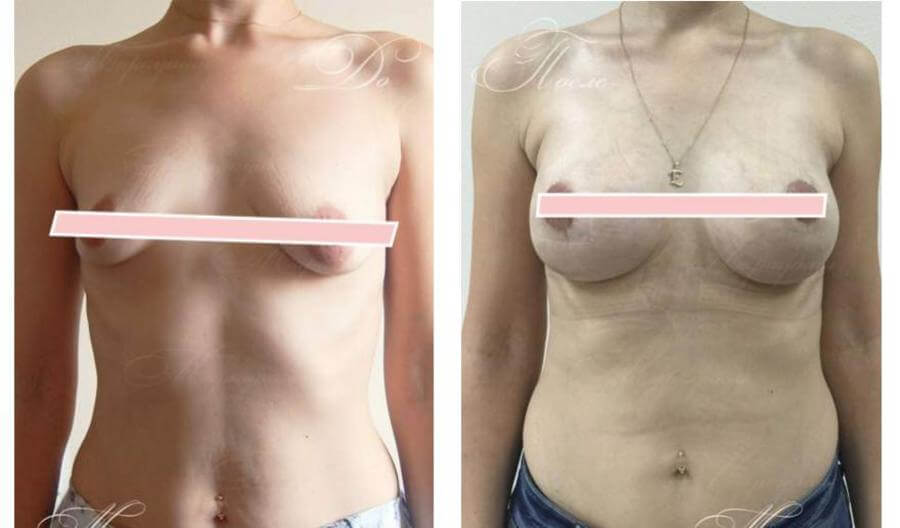 Фото до после увеличения и пластики тубулярной груди