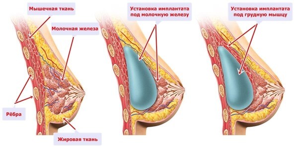 Установка импланта в груди