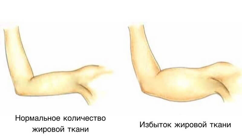 Как выглядит рука в норме и с жировым отложением