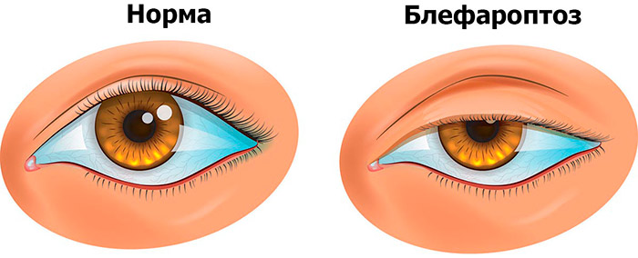 Блефароптоз - неудачная блефаропластика и ее последствия