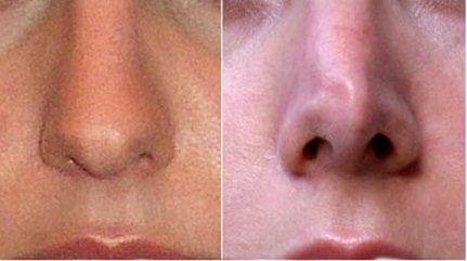 Фото до после неудачной ринопластики: деформация носа
