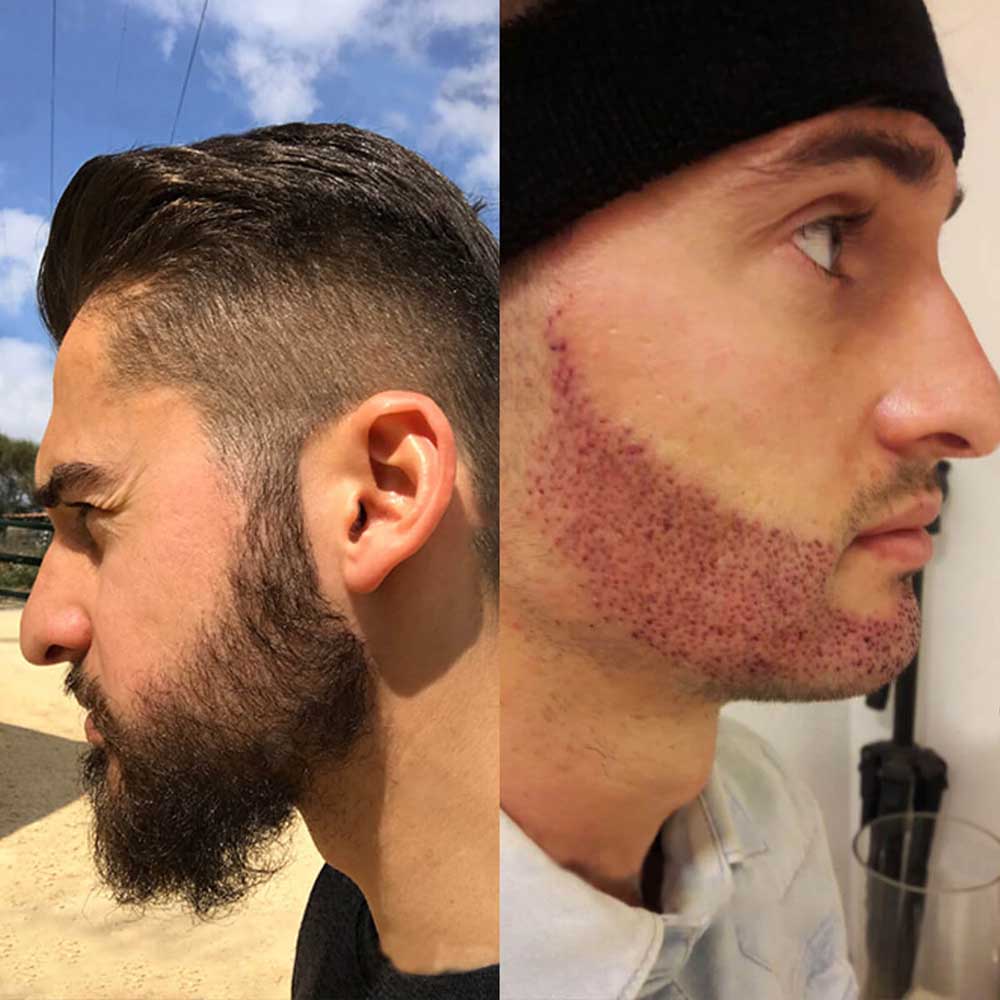 После бороды на коже
