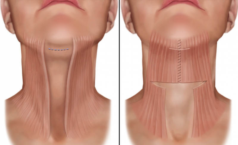 Платизмопластика шеи