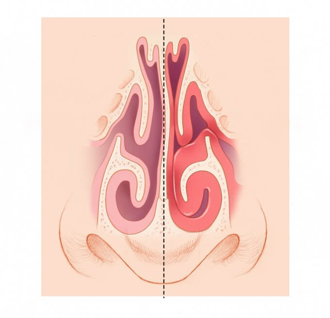 Септопластика: какие показания к процедуре?