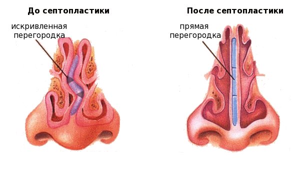 Септопластика: показания к процедуре?