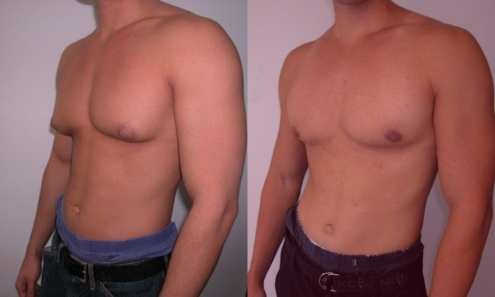 Фото до после уменьшения груди у мужчин 