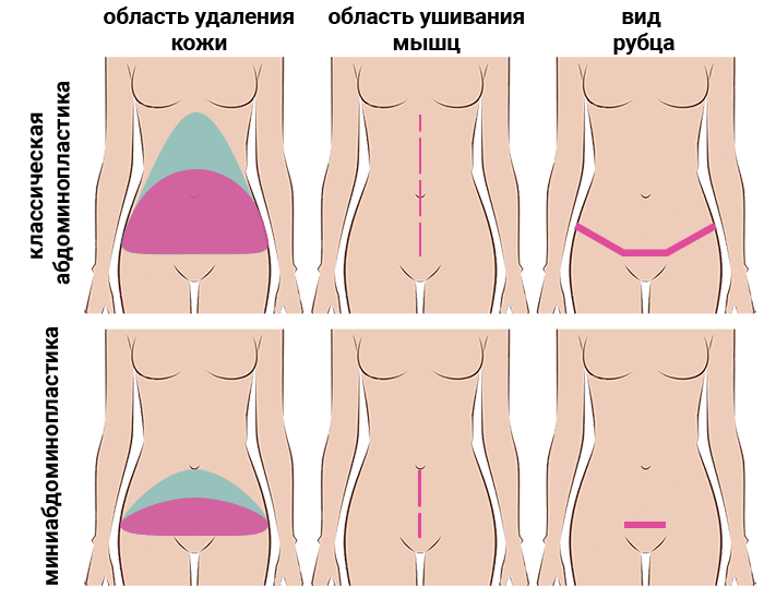 Схематическое объяснение миниабдоминопластики