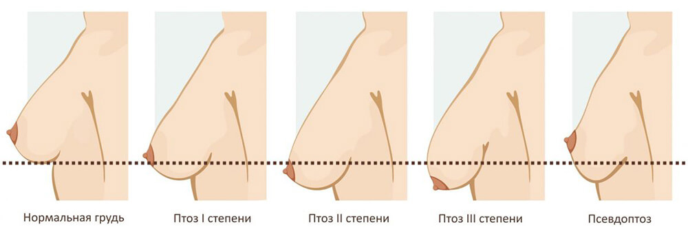 нужна ли вам подтяжка груди