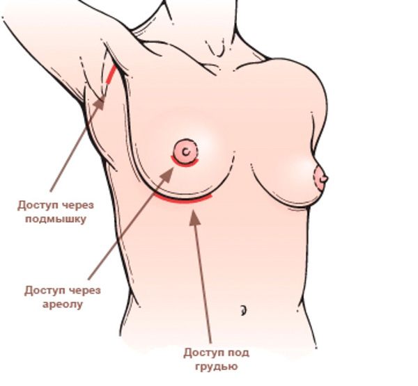 Варианты доступа пли пластике груди