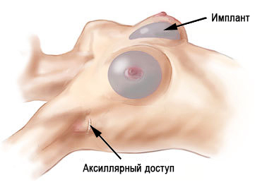 Аксиллярный доступ фото