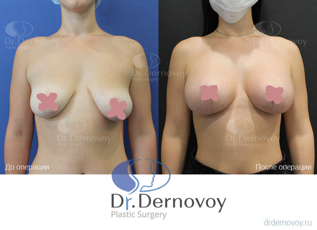 Фото до и после якорной мастопексии с имплантами, пластический хирург Дерновой Сергей Сергеевич