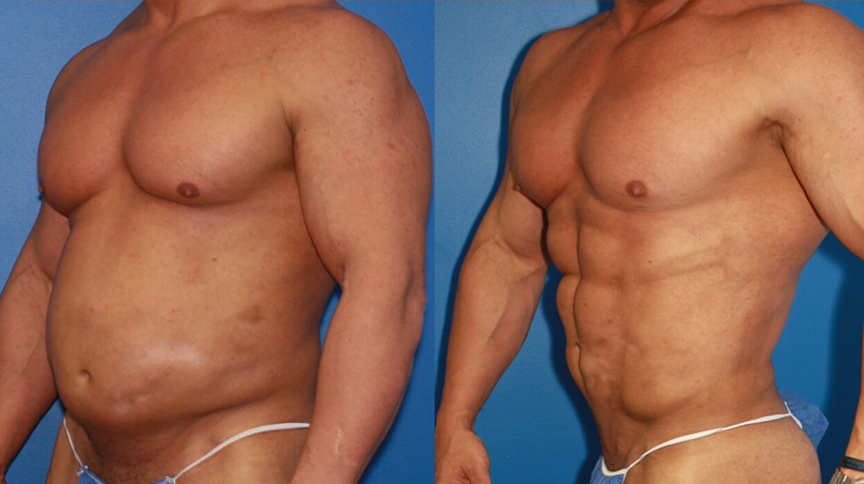 удаления жира с груди у мужчин фото 25