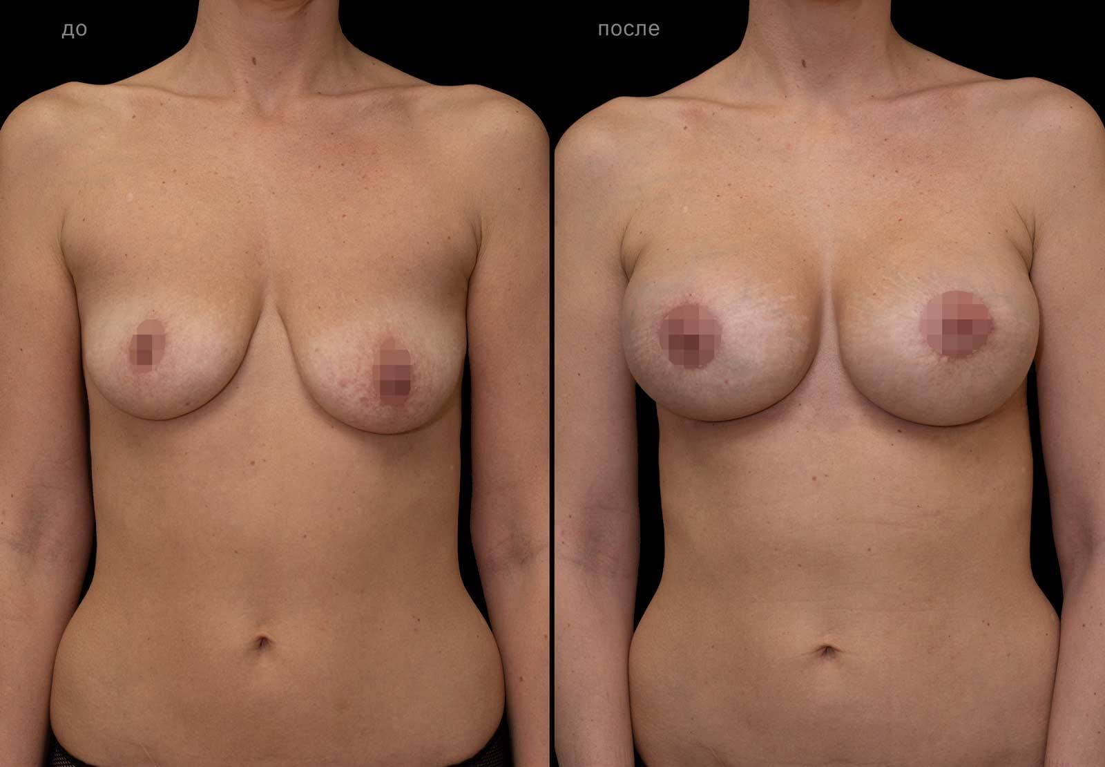 почему у женщин одна грудь меньше фото 110