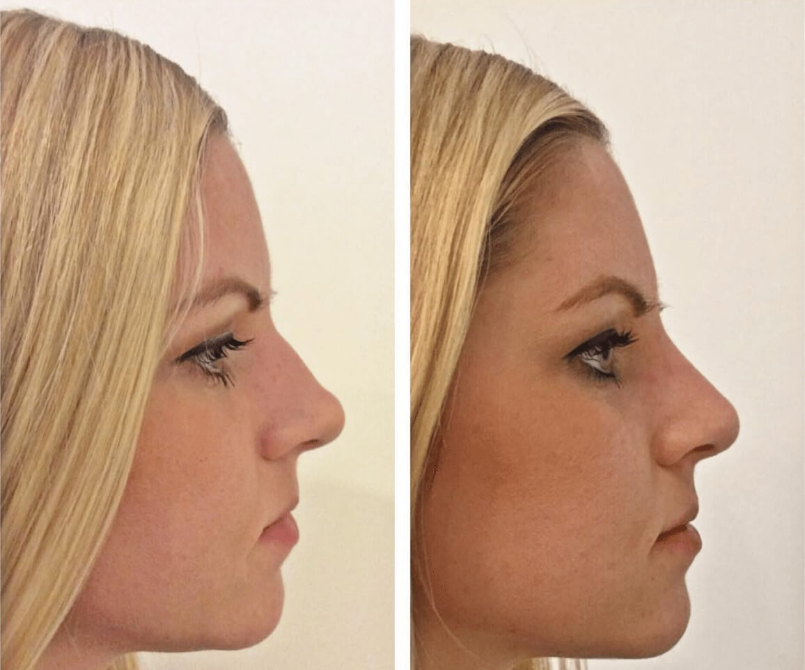 Фото ринопластики до и после нос. Седловидный нос ринопластика. Ринопластика горбинки. Безоперационная ринопластика.