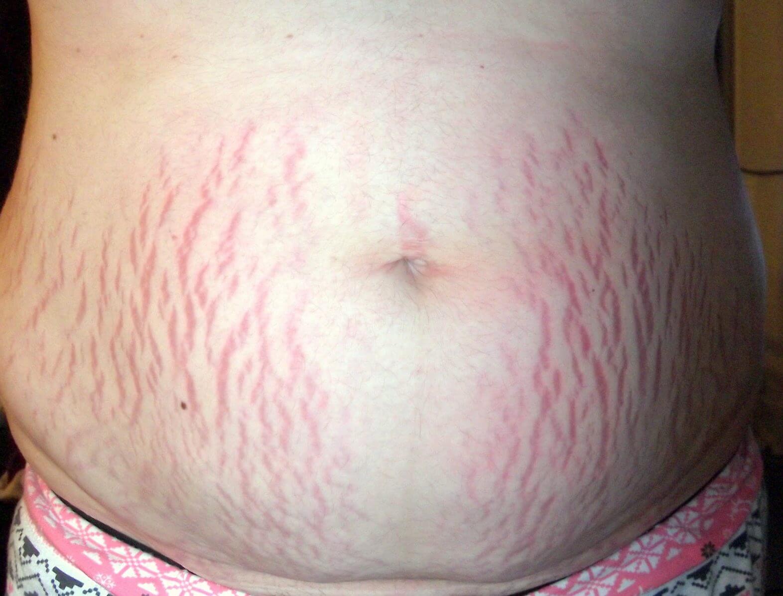 растяжки на груди во время беременности фото фото 42