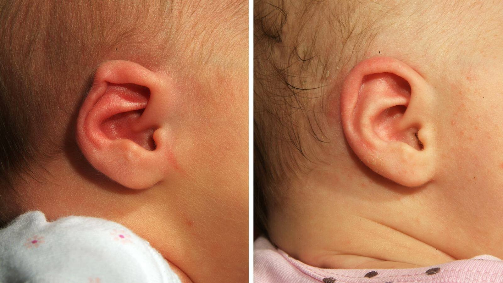 Врожденные деформации ушей чаще оперируют не раньше 7-9 лет, но бывают исключения