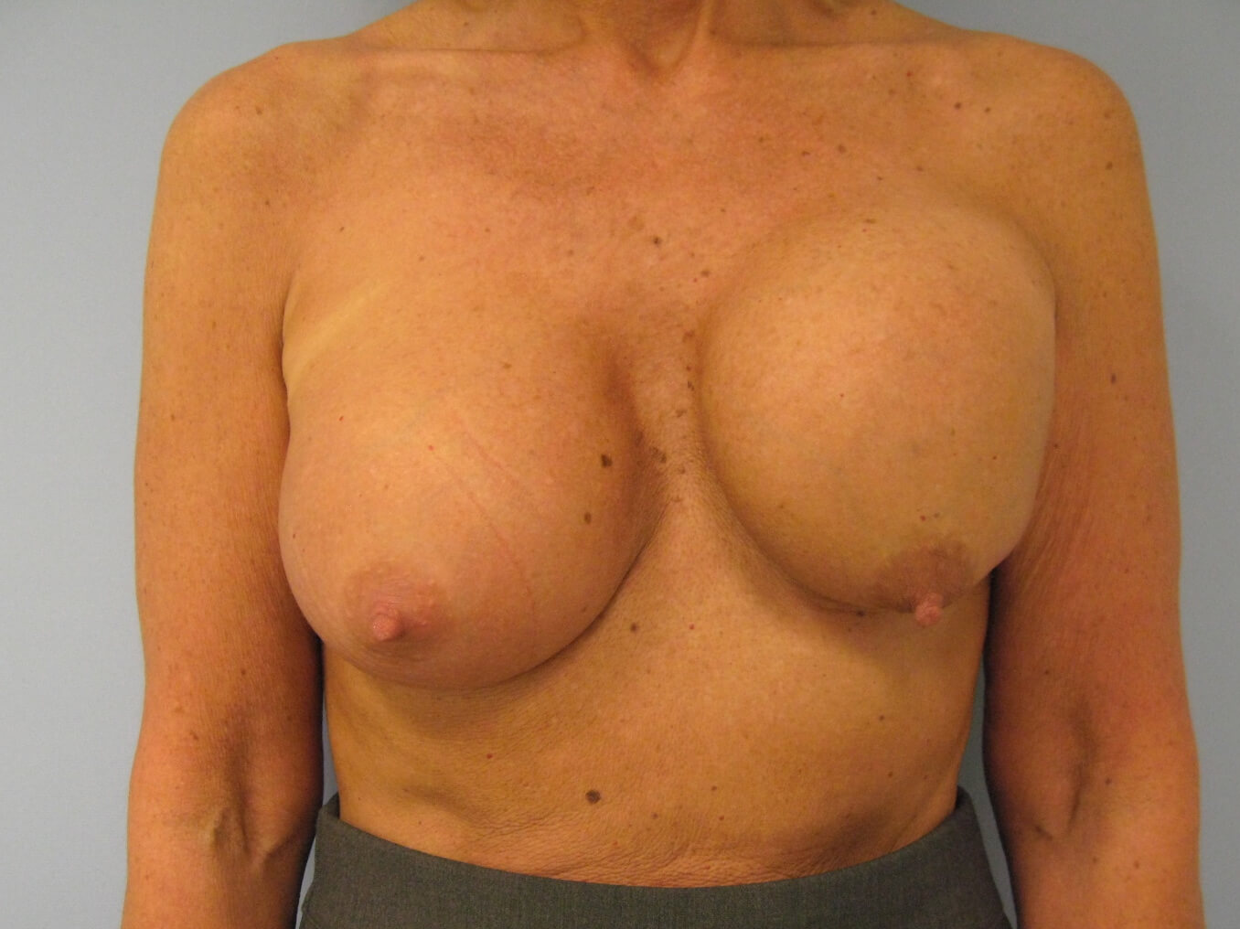 маммопластика одна грудь ниже другой фото 28