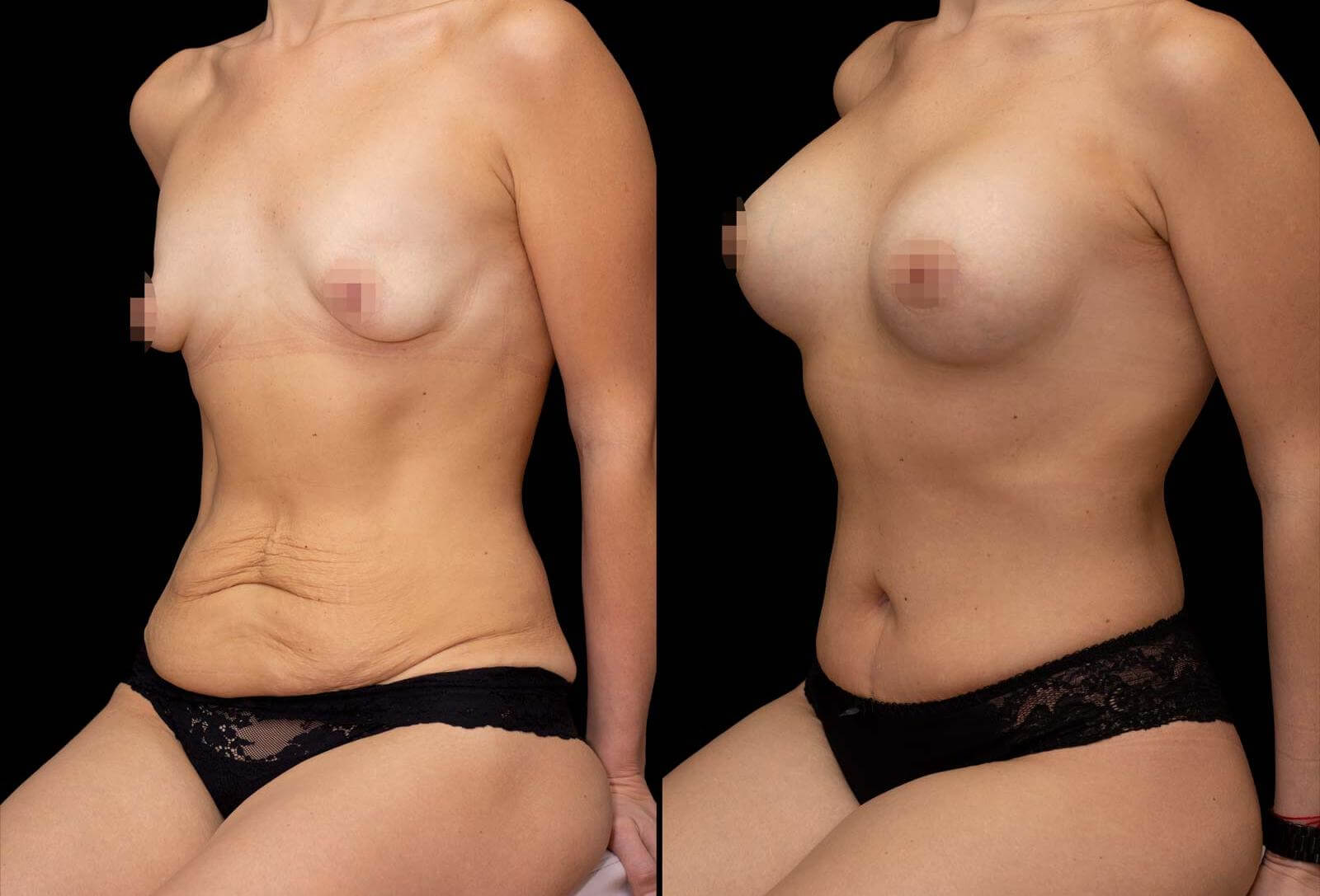 голая женщина до и после родов фото фото 82