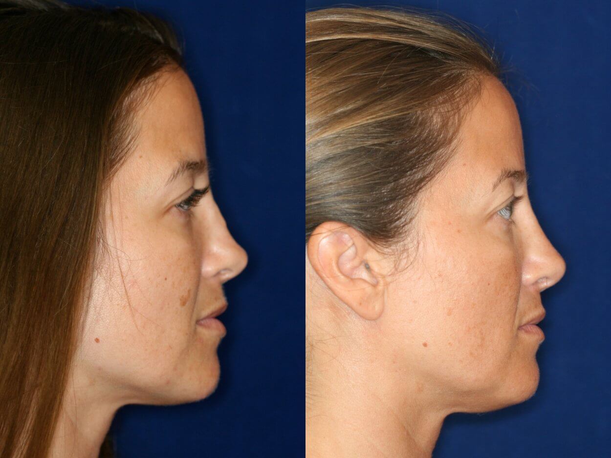 Нос до и после ринопластики с горбинкой