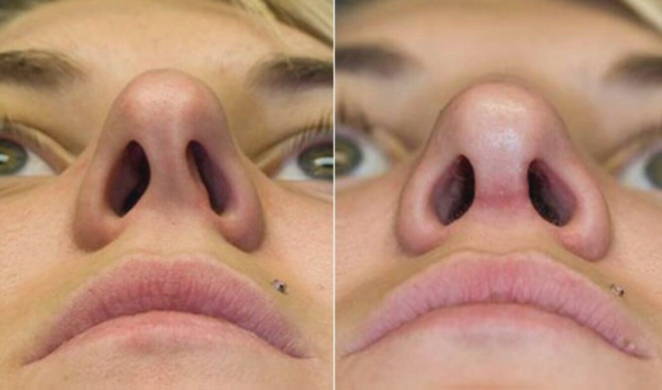Перегородка носа без операции