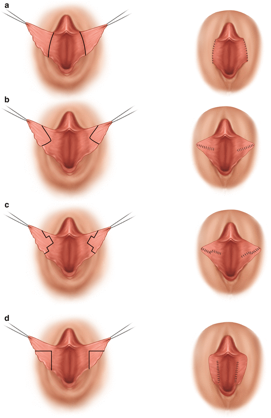 Варианты выполнения лабиопластики