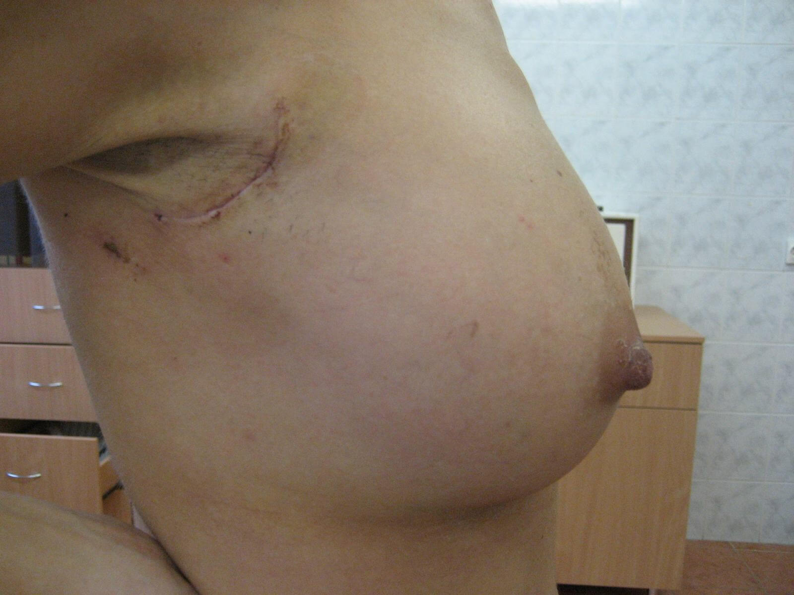 форум женщин с кистой груди фото 42