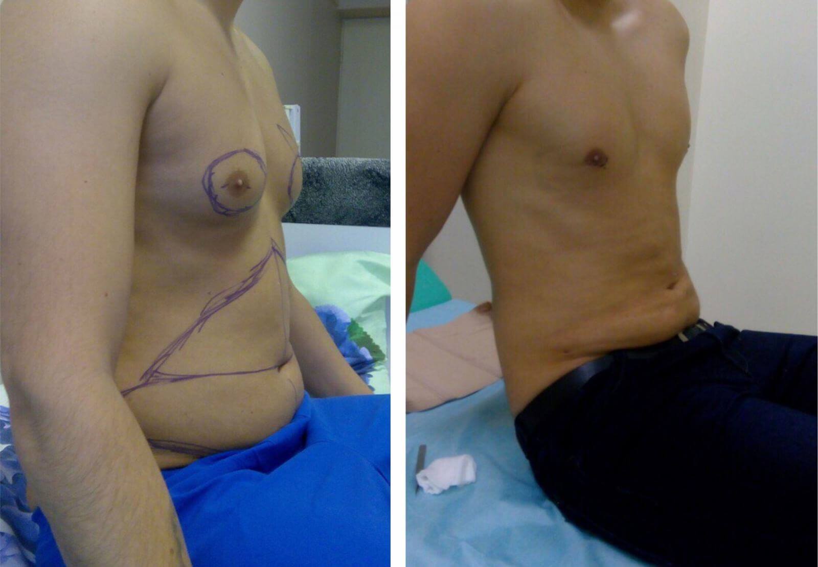 стоимость липосакции груди у мужчин фото 21