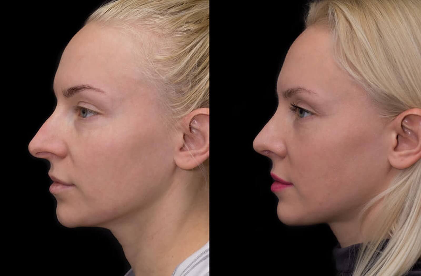 Пластика носа до и после фото женщины