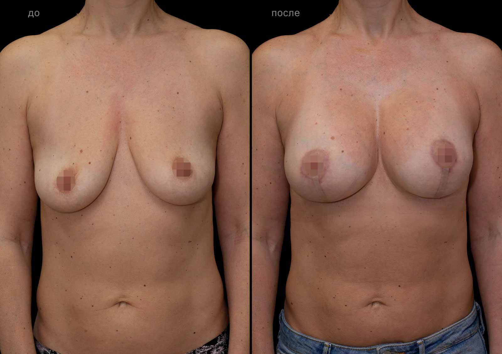 подтяжка груди с увеличением размера фото 62