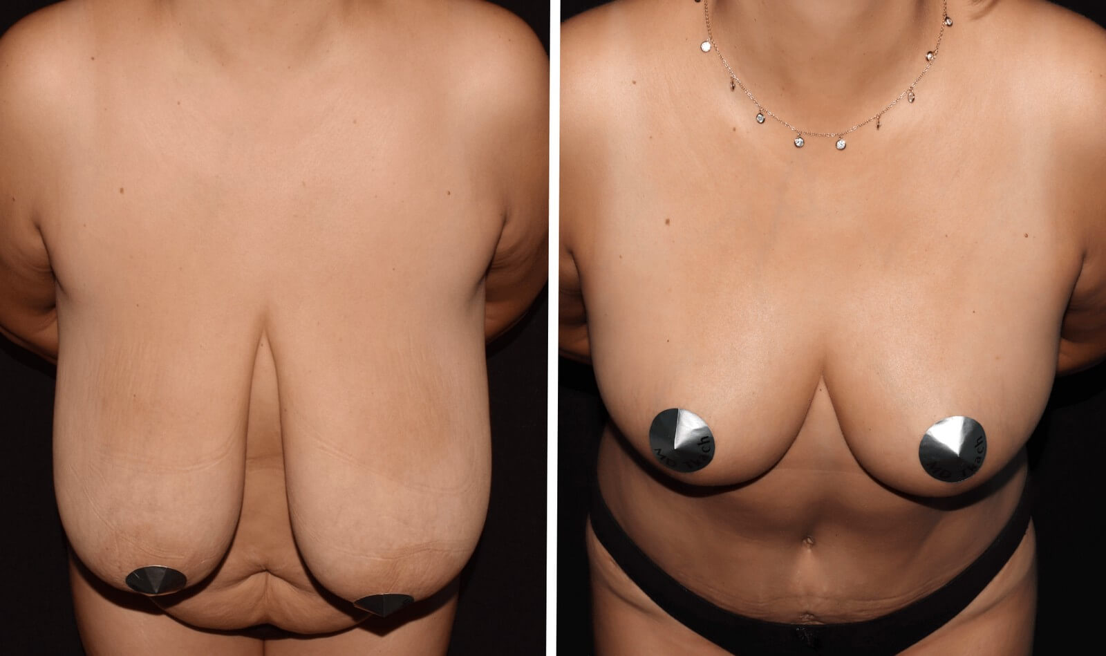 подтяжка груди с гантелями для женщин фото 5