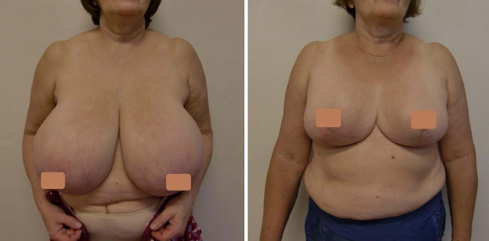 уменьшение груди у женщин в домашних условиях фото 4