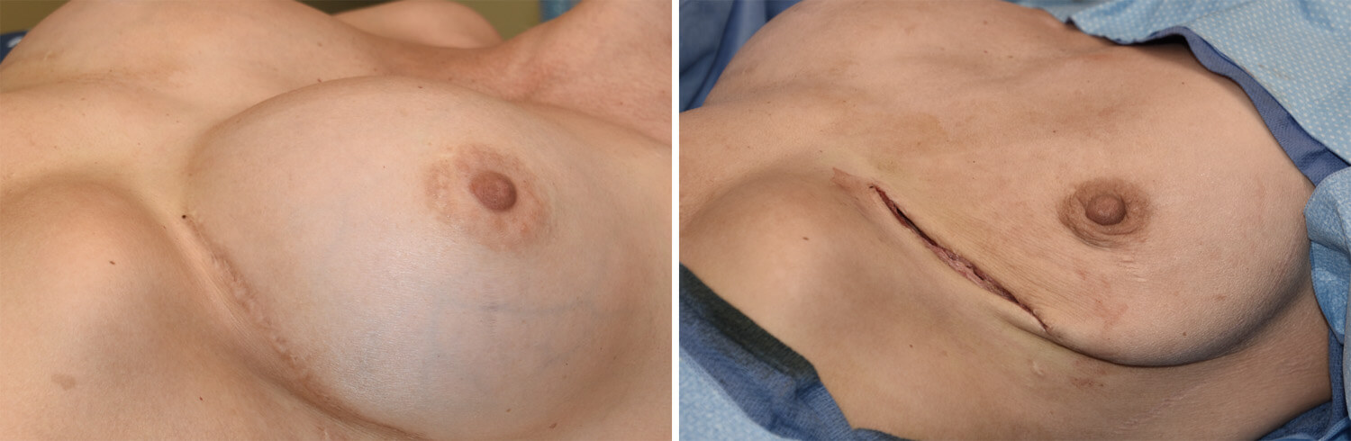 После удаления имплантов грудь выглядит как сдутые шарики. Нужна подтяжка, а иногда и новые эндопротезы