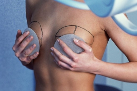 О чем нужно и не нужно переживать при выборе имплантов для увеличения груди