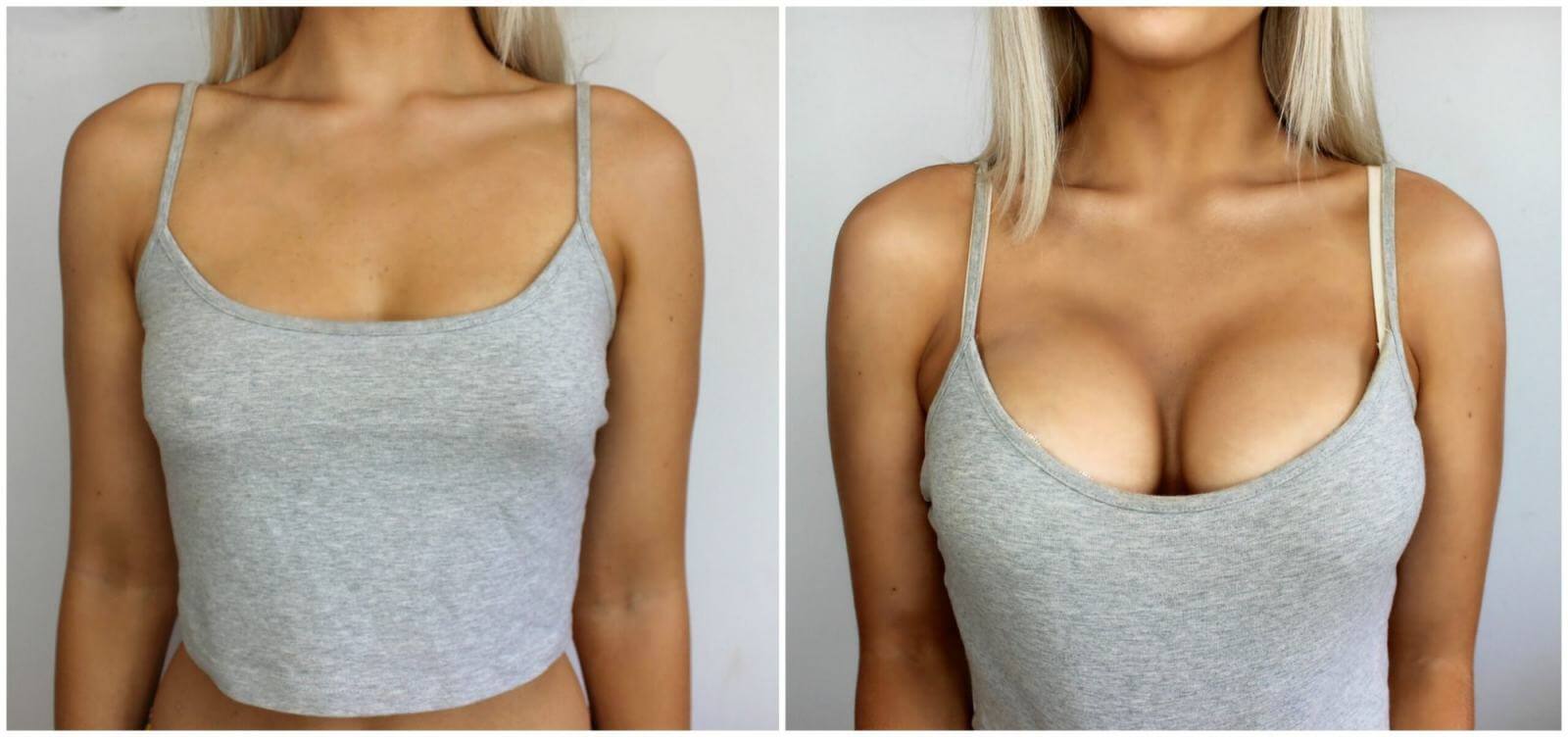 Увеличение груди – до и после