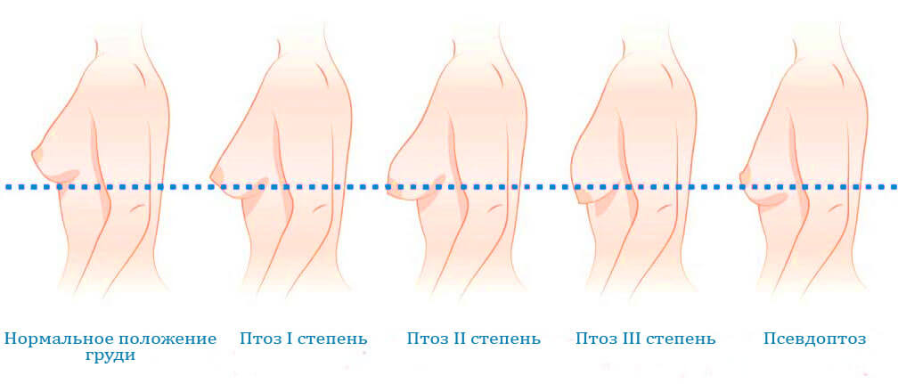 Степени птоза груди. У пышногрудых красавиц 2-3 стадия часто наступает еще до 30 лет