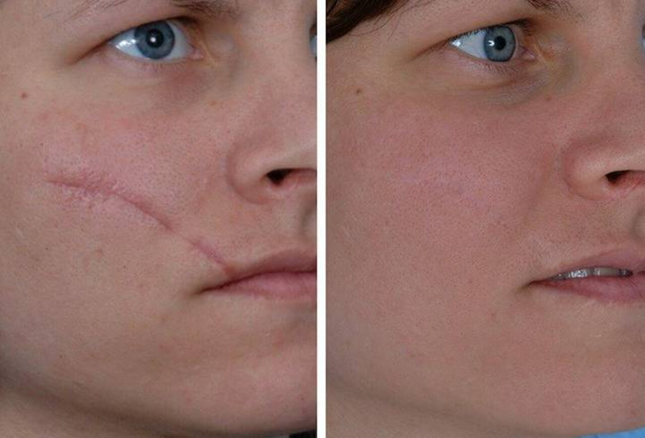 Липофилинг в комплексе с лазерной шлифовкой отлично удаляет шрамы на лице