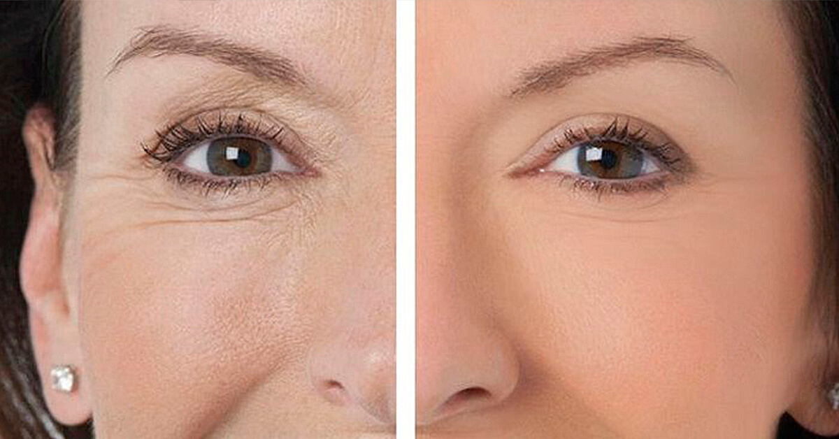 Морщины вокруг глаз сильно старят лицо вне зависимости от состояния остальной кожи