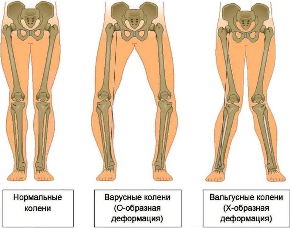 Разные варианты искривления ног