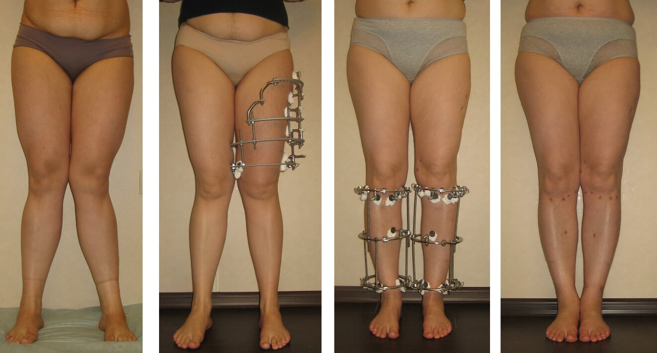 На использование аппарата Илизарова для коррекции кривизны ног согласятся далеко не все