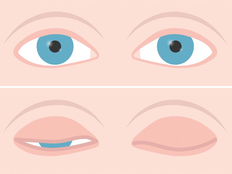 При лагофтальме один или оба глаза не закрываются полностью