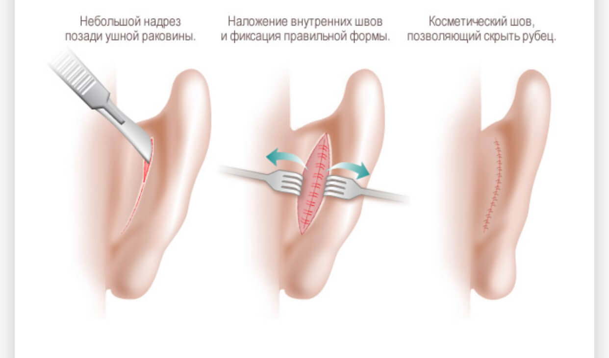 Пластика Уха Фото