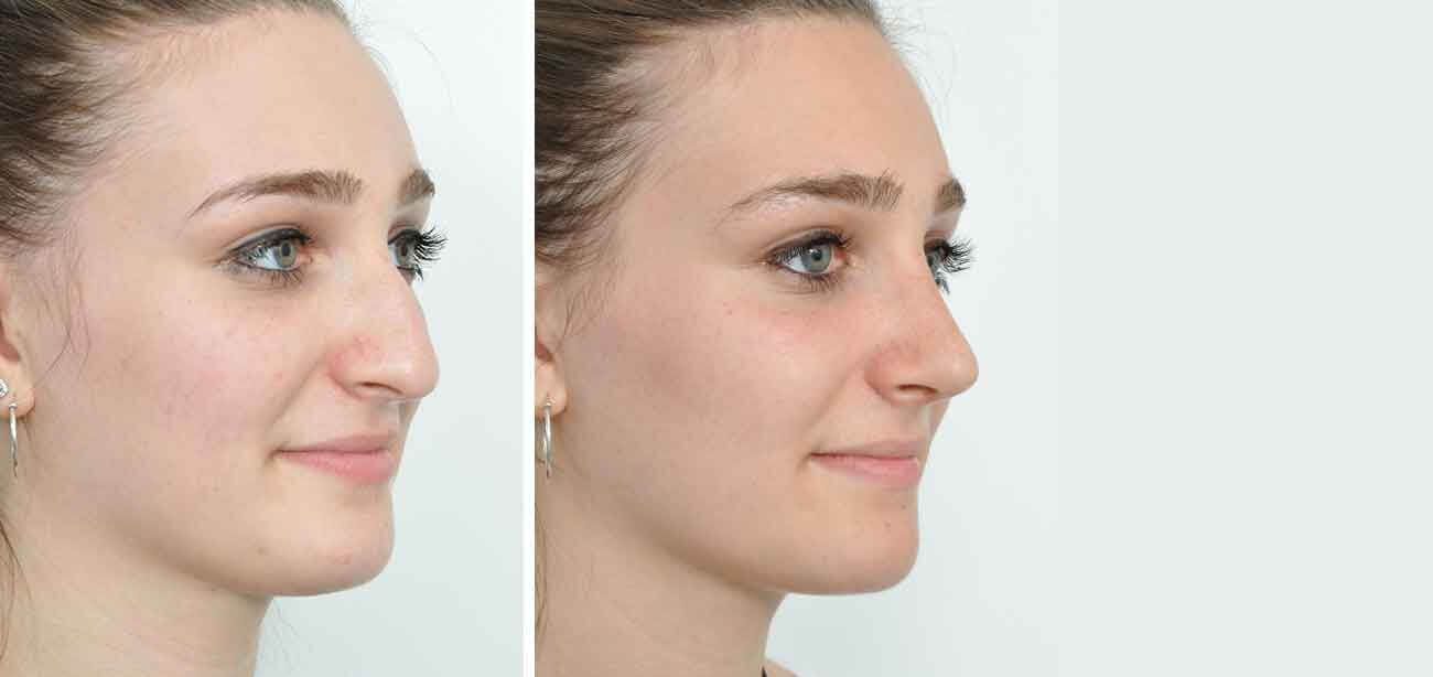 Нос после операции отзывы. Ринопластика. Ринопластика носа. Пластическая операция на нос. Ринопластика до и после.