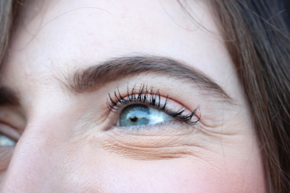 Морщины под глазами и нависшее верхнее веко – главные показания к пинч-блефаропластике