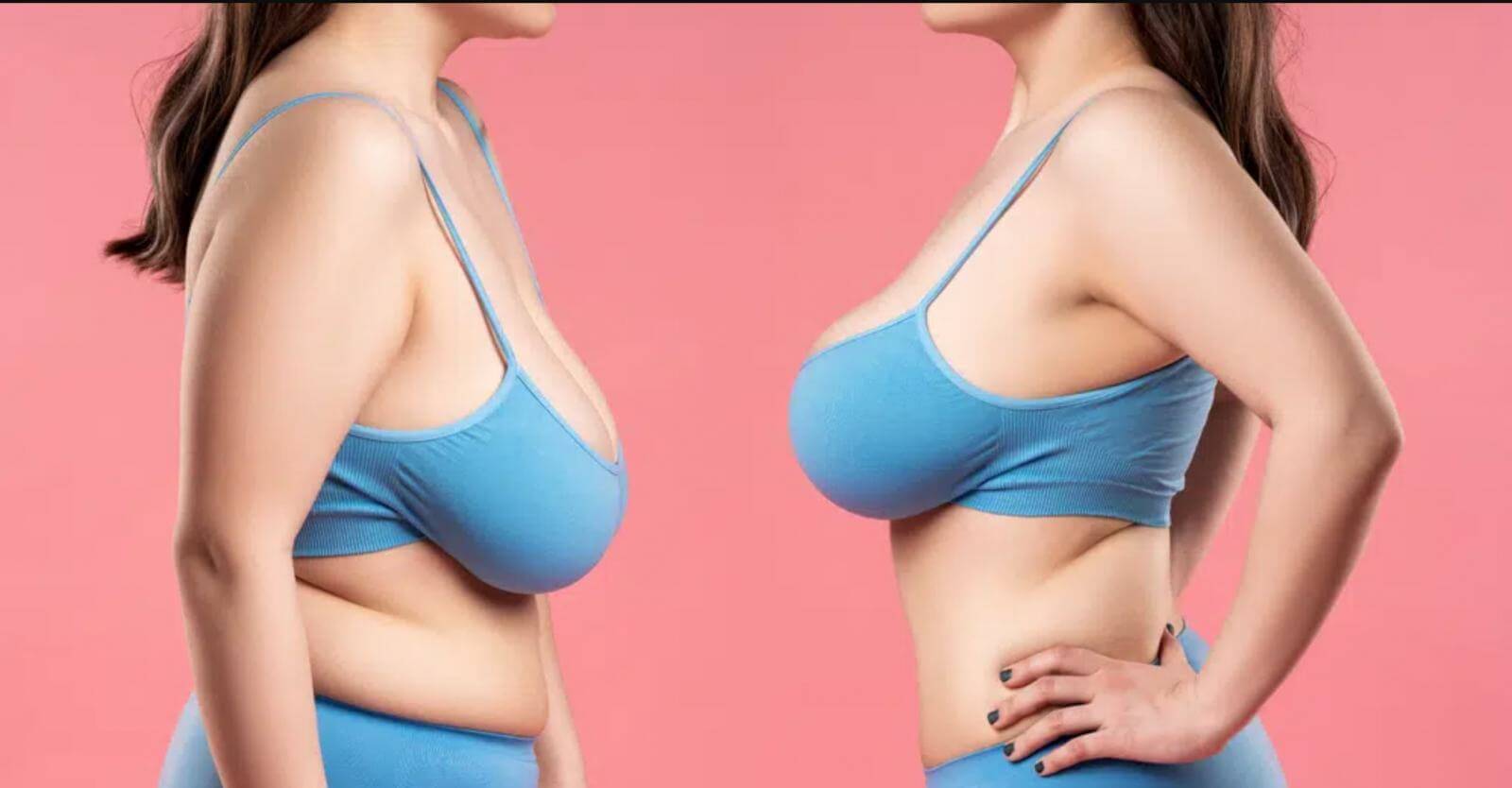 Рожавшие женщины чаще всего хотят исправить птоз груди