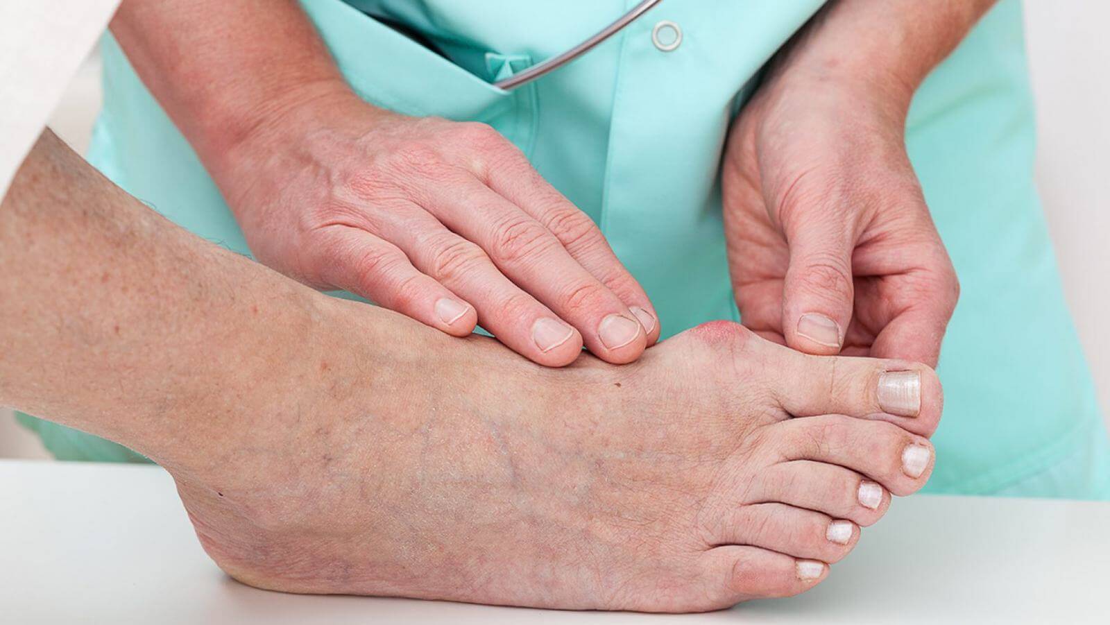 Врач лечащий суставы ног. Ревматоидный артрит тофусы. Болезнь суставов подагра.